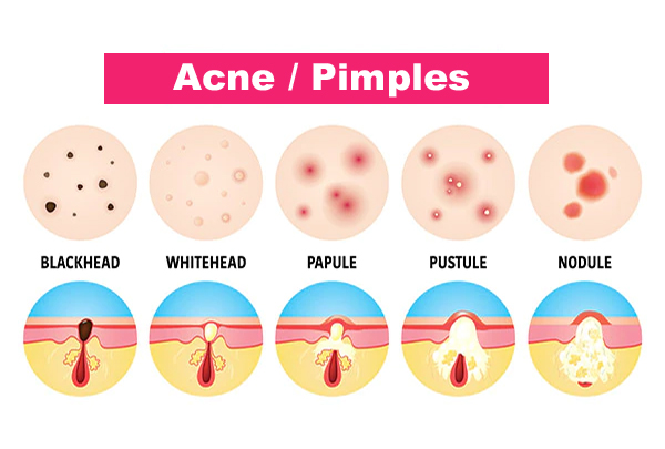 Acne/Pimples