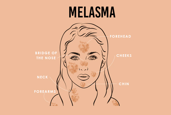 Melasma (Black Spots)