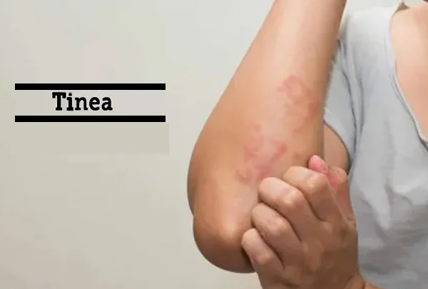 Tinea (Fungal Infection)