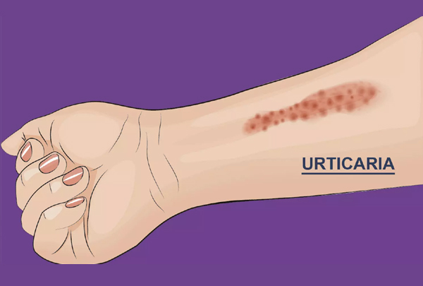 Urticaria