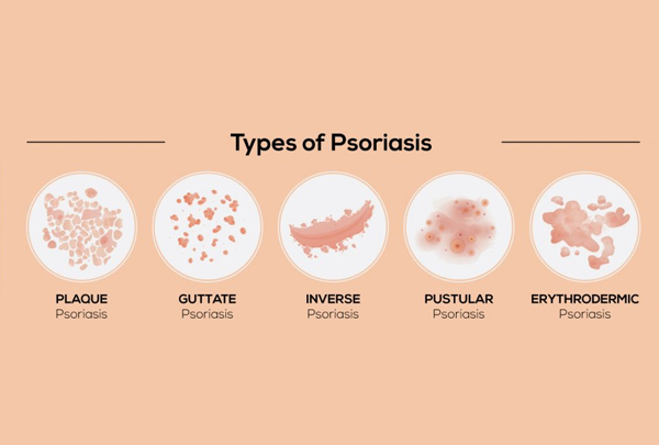 Psoriasis