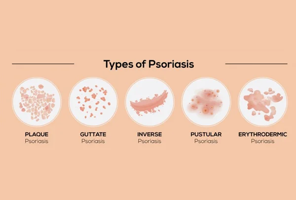 Psoriasis