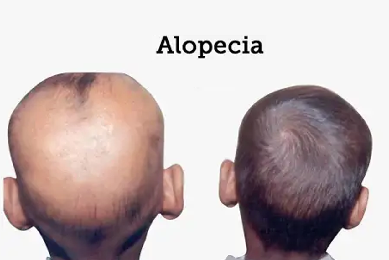 Alopecia Areata