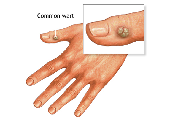 Warts Removal